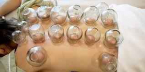 Stawianie baniek ogniowych Siedlce